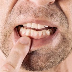 Opuchlizna od zęba – przyczyny i sposoby łagodzenia