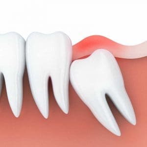 Zęby mądrości – czym jest ząb mądrości i czy warto usuwać ósemki?