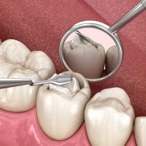 Nieleczona próchnica zębów – cichy zabójca całego organizmu