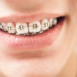 Aparat ortodontyczny – co warto wiedzieć?
