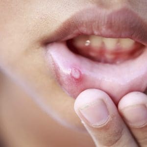 Pleśniawki w jamie ustnej – czym są i jak się ich pozbyć?