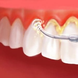 Skaling zębów – na czym polega, jakie są zalety i przeciwskazania?