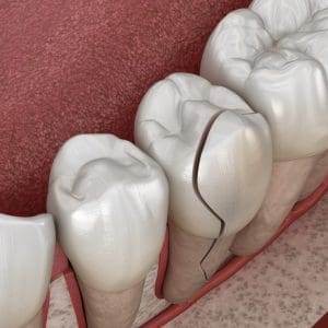 Pęknięty ząb – co należy zrobić?