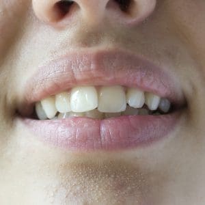 Krzywe zęby – jak je wyprostować?