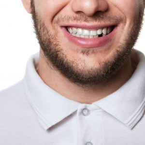 Brak zęba – dlaczego braki w uzębieniu należy szybko uzupełnić?