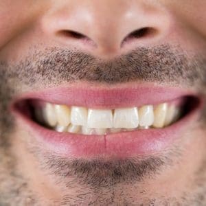 Przezroczyste zęby – co to jest i jak zapobiec erozji szkliwa?