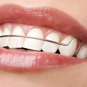 Retainer na zęby (aparat retencyjny) – co to, dla kogo, jak długo nosić?
