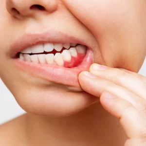 Czy czerwone dziąsła to dobry powód, aby odwiedzić dentystę? 