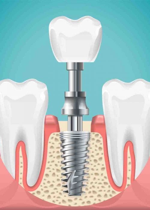 Dental surgery. Tooth implant cut vector illustration. Healthy teeth and dental implant, stomatology poster. Implant dental metal screw in gum